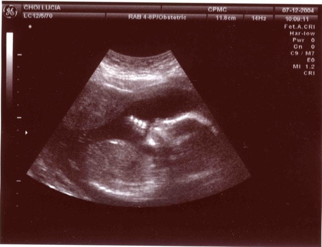 Ecografía de un feto en el útero materno